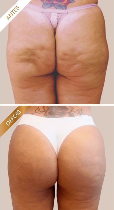 Antes e Depois GoldIncision 2
